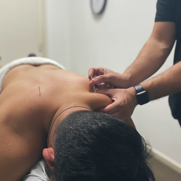 Dry needling treatment at Dynamic Therapy